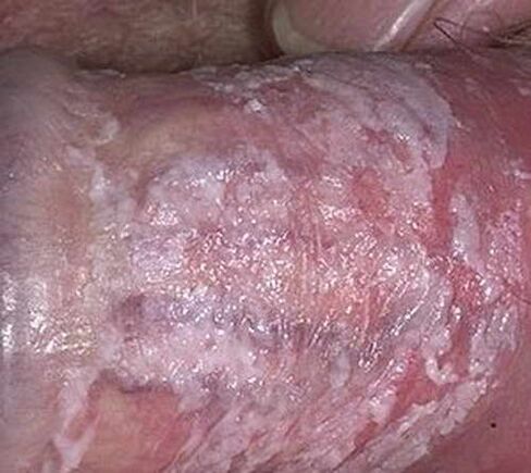 clotted discharge when excited