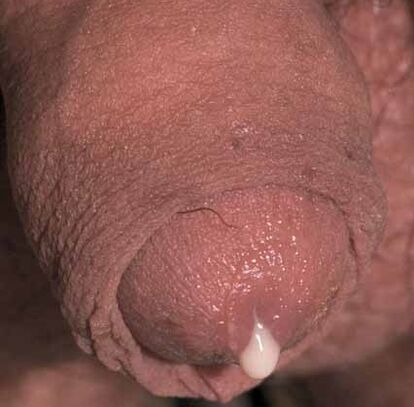pathological discharge when excited